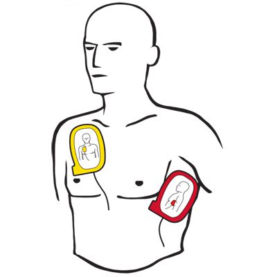 Automated External Defibrillator Pad Placement