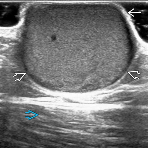 Subcutaneous Dermoid Cyst Ultrasound