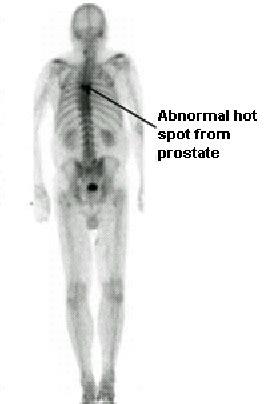 llustrates 2. Abnormal the bone (cancer scan detected) showing bone the ...