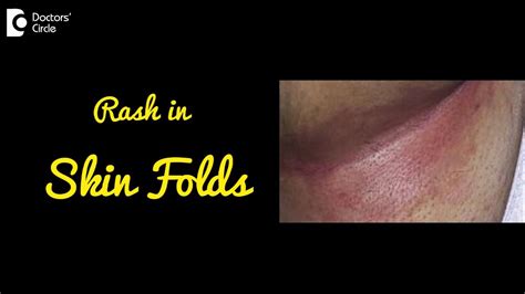 Candidiasis Skin Folds