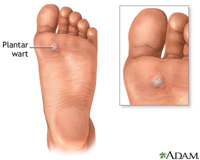 Plantar wart: MedlinePlus Medical Encyclopedia Image