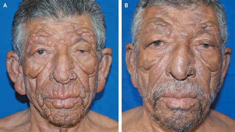 Leonine Facies: Lepromatous Leprosy | NEJM