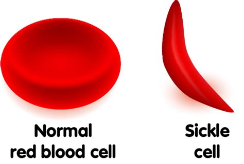 Sickle Cell Anemia
