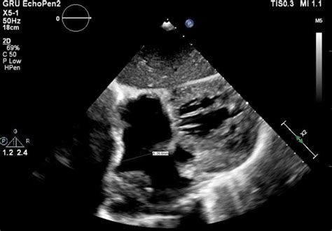 Atrioventricular Septal Defect Ultrasound