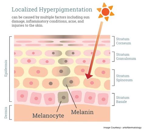 Irritated with Hyperpigmentation? Hyperpigmentation causes and Treatment