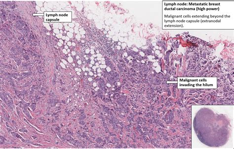 Metastatic Squamous Cell Carcinoma Lymph Node