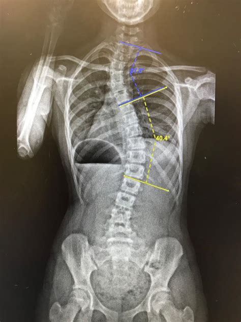 Scoliosis Spine X Ray