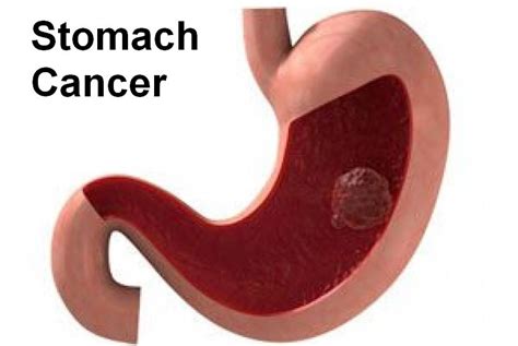 Stomach Cancer: Causes, Symptoms, Diagnosis And Treatment