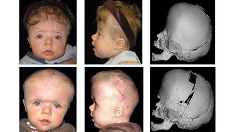 Craniosynostosis Surgery | Children's Hospital of Philadelphia