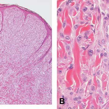 Histology of Spitz nevus. A. Symmetric compound nevus with sharp... | Download Scientific Diagram