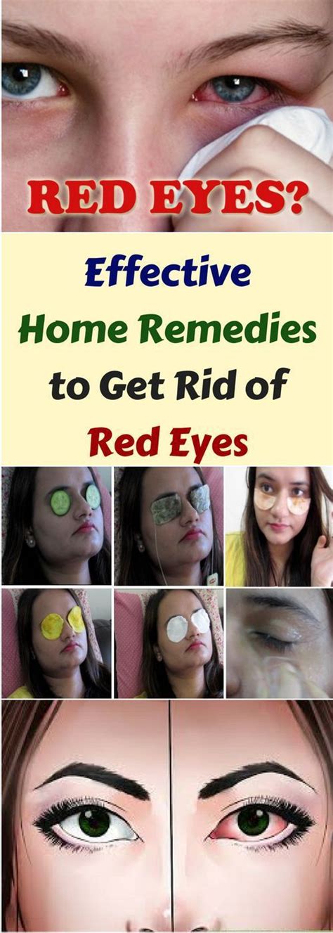 Effective Home Remedies To Get Rid Of Red Eyes - Kok Vannak | Red eyes remedy, Home remedies ...
