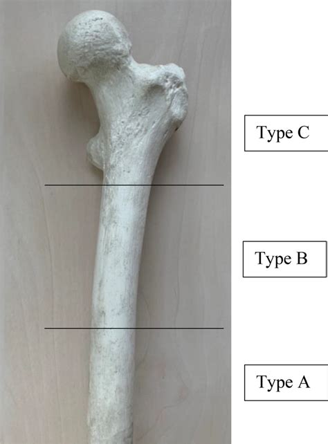 Description of the level for intra- and postoperative periprosthetic ...