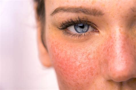 Pulsed dye laser as effective as other laser therapies for managing rosacea,claims study