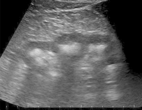 Ultrasound of the right kidney shows marked medullary nephrocalcinosis.... | Download Scientific ...