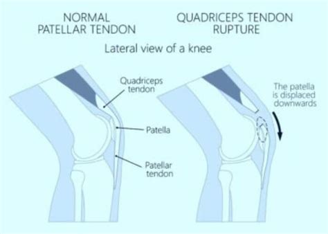 Quadriceps Tendon Rupture Repair Surgery |Orthopedic Knee Surgeon ...