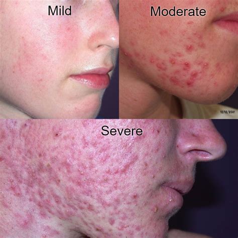 Types of Acne With Pictures: Mild, Moderate, Severe... - eHealthStar