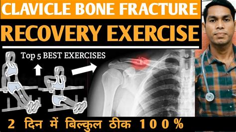Clavicle exercise after surgery, broken, fracture, mobility, injury, collarbone exercises for ...