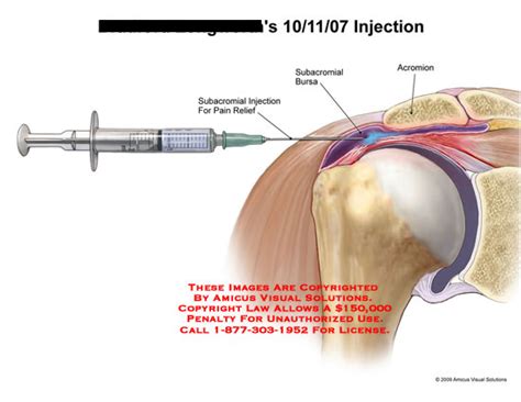 AMICUS Illustration of amicus,surgery,injection,rotator,cuff,tear ...