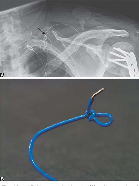 Figure 1 from Knotting of a Perineural Catheter Inserted with Ultrasonography | Semantic Scholar