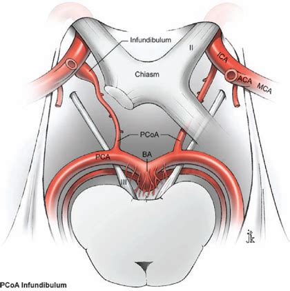 Posterior Communicating Artery Aneurysms | Neupsy Key