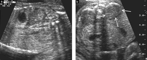 Fetal Adrenal Glands Ultrasound