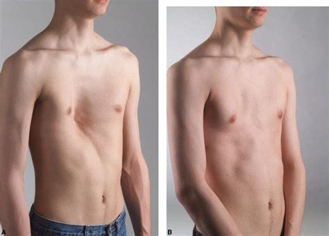 Minimally invasive correction of pectus excavatum in adult patients - The Journal of Thoracic ...