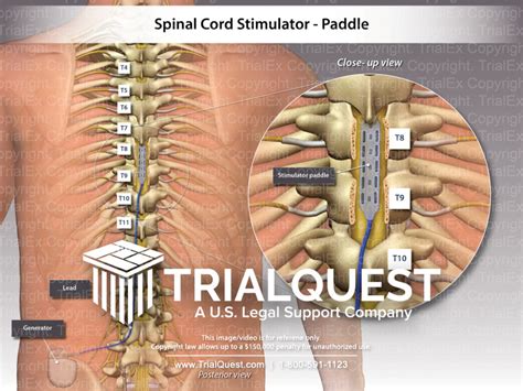 Spinal Cord Stimulator - Paddle - TrialQuest Inc.