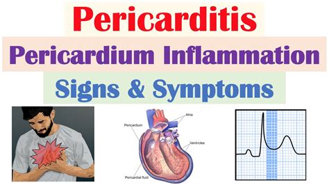 Pericarditis (Pericardial Inflammation) Signs & Symptoms (& Why They Occur) - YouTube