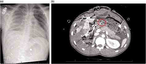 New fragmenting bullet leads to unexpected injury pattern: A case report involving the Radically ...