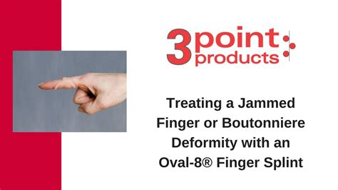 How to Treat Boutonniere Deformity with an Oval-8 Finger Splint - YouTube