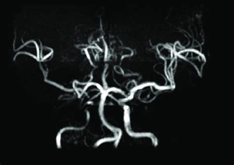 MRA showed stenosis of right ICA. ICA = internal carotid artery, MRA ...