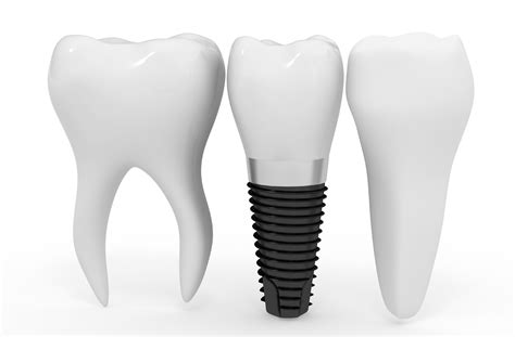 Dental Implants 101 - Downtown Dental Nashville