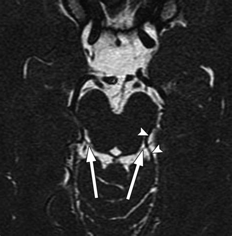 Trochlear Nerve Mri