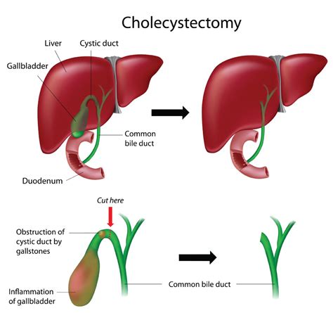 Gallbladder Surgery | Bile Ducts Surgery | Weightloss Operations