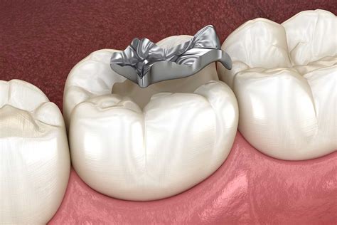 SMART Removal of Amalgam | Costa Mesa Metal Fillings