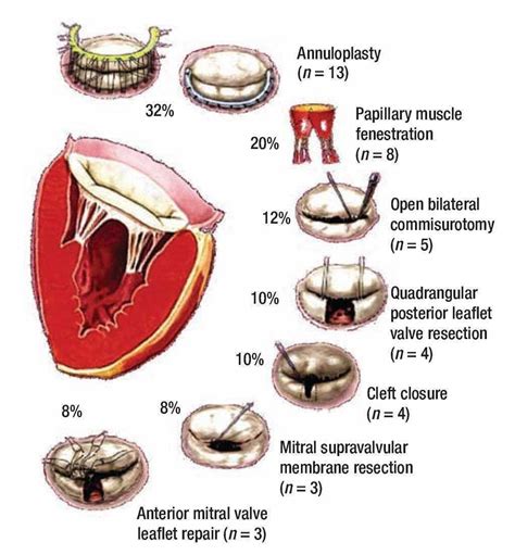 Cleft Mitral Valve