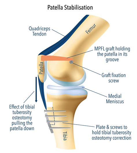 Patella Stabilization Surgery | MPFL Reconstruction Surgery