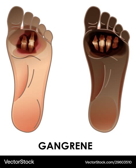 Diabetic foot gangrene ulcers skin sores on Vector Image