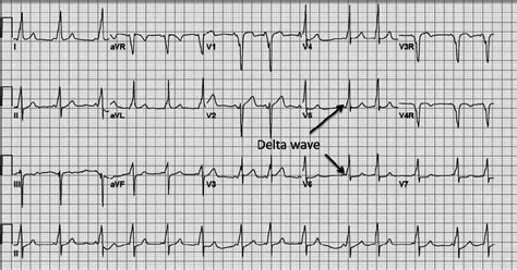 ECG demonstrating the classic fi ndings of Wolff – Parkinson – White... | Download Scientific ...