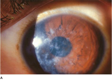 Corneal Dystrophies | Ento Key