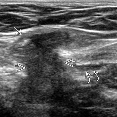 Inguinal Hernia Female Ultrasound