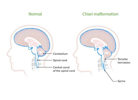 Chiari Malformation - Hart Garner, MD