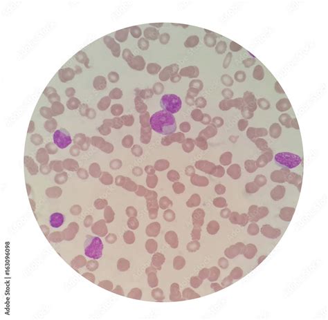 Blood smear under microscope present red blood cell abnormal morphology ...