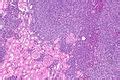 Marginal zone lymphoma - Libre Pathology