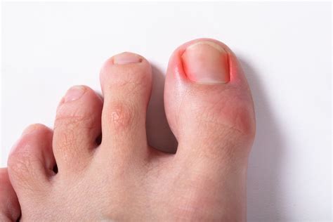 What Should You Expect from Ingrown Toenail Surgery? - Foot & Ankle ...