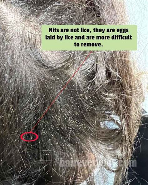 How To Remove Nits From Hair Without A Comb | Permanent And Painless Methods! - Hair Everyday Review