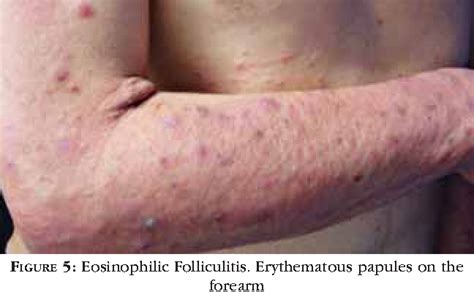 Figure 1 from Neutrophilic dermatoses-Part I Dermatoses neutrofílicas – Parte I | Semantic Scholar