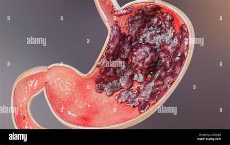 Early Stage Stomach Cancer Symptoms