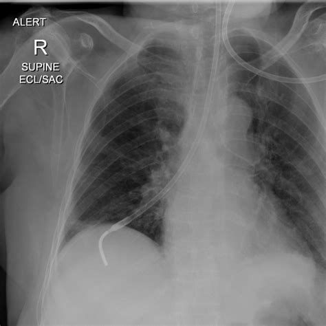 Dobhoff Tube Placement Length / Learningradiology Dobhoff Dobbhoff Tube ...