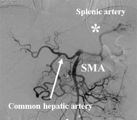 Superior Mesenteric Artery Angiogram